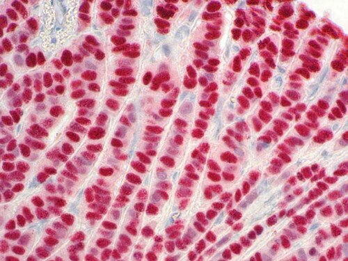 IHC of Estrogen Receptor on a FFPE Breast Tissue